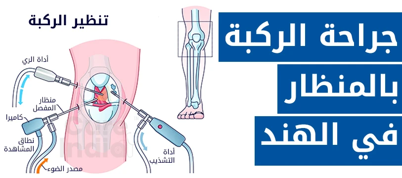 جراحة منظار الركبة في الهند